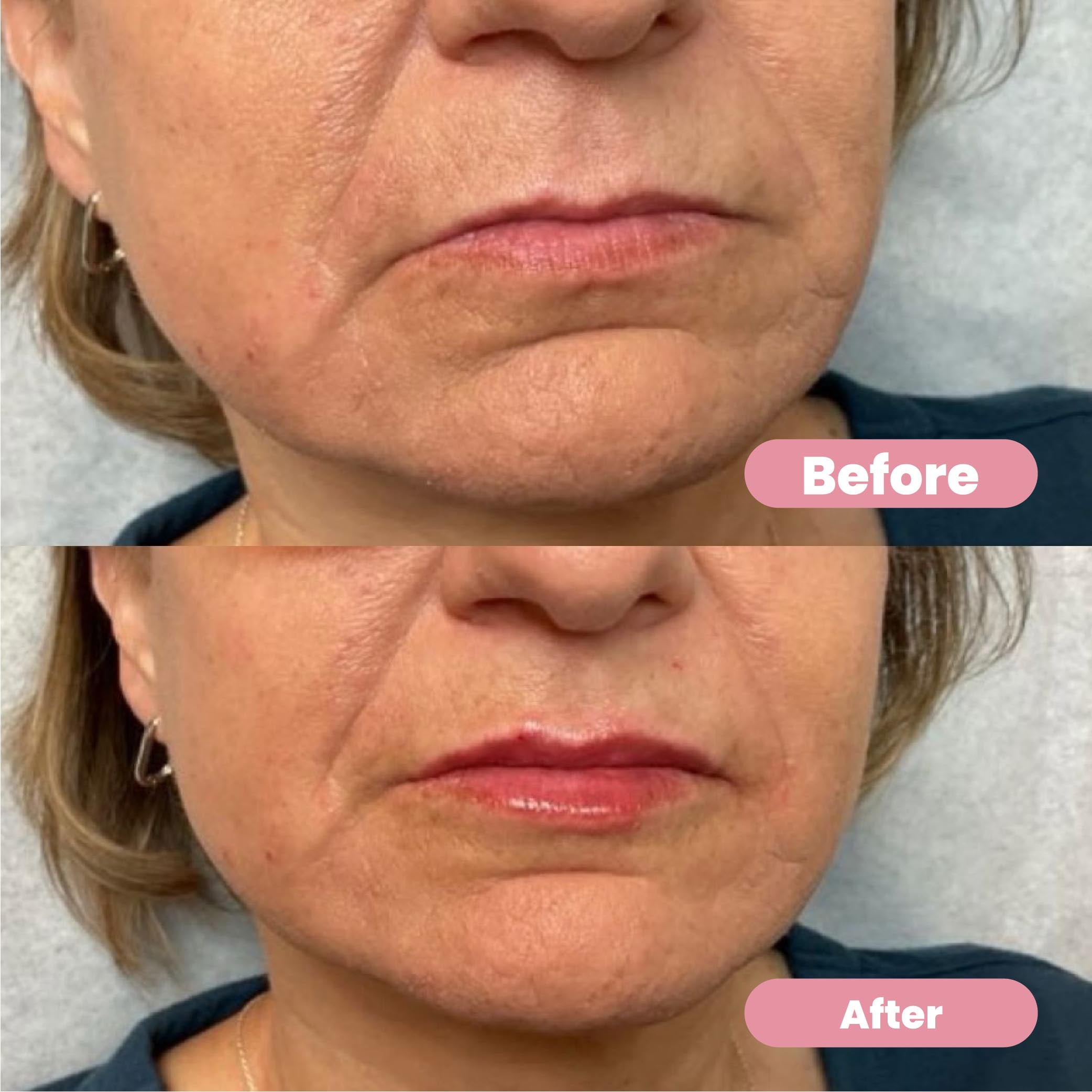 Ubiskin™ At-Home Rejuvenating Microinfusion System