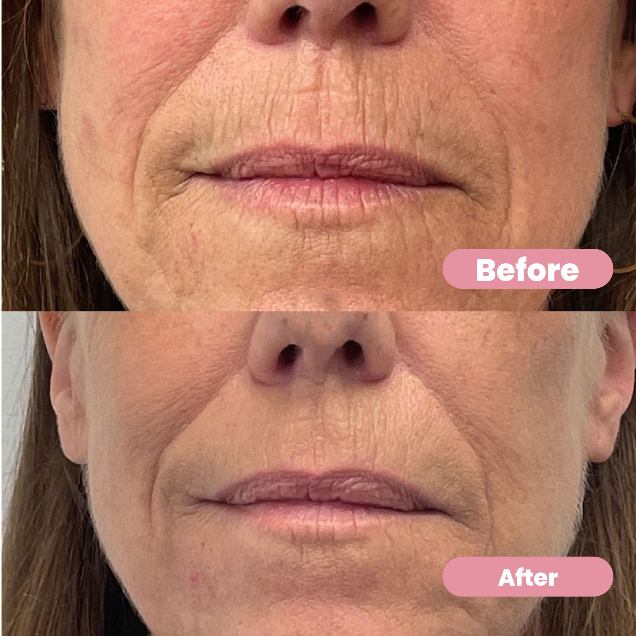 Ubiskin™ At-Home Rejuvenating Microinfusion System