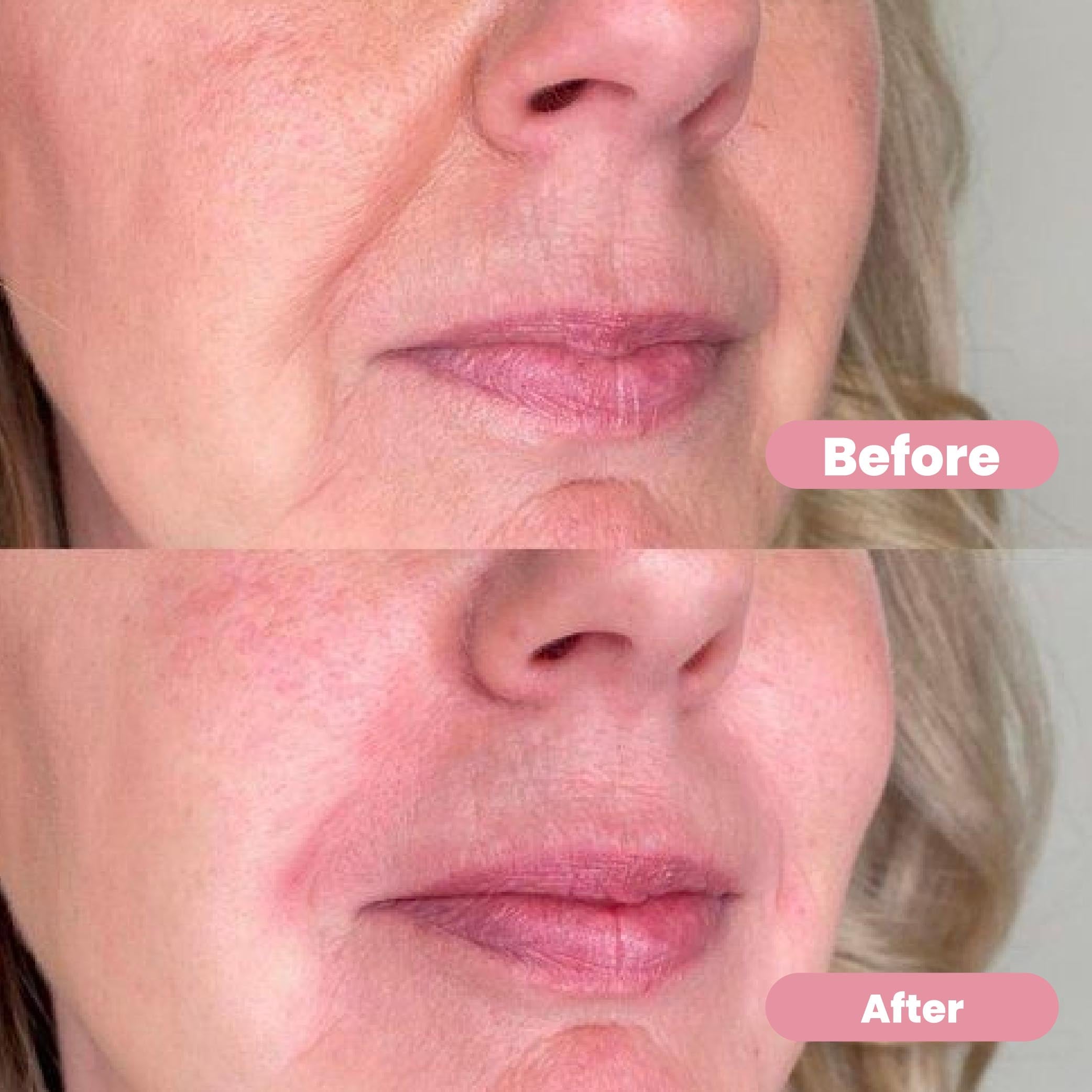 Ubiskin™ At-Home Rejuvenating Microinfusion System