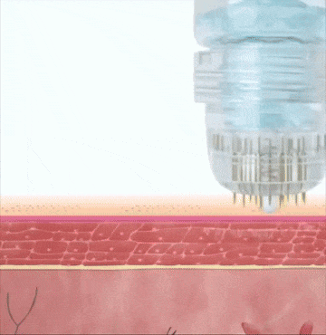Ubiskin™ At-Home Rejuvenating Microinfusion System