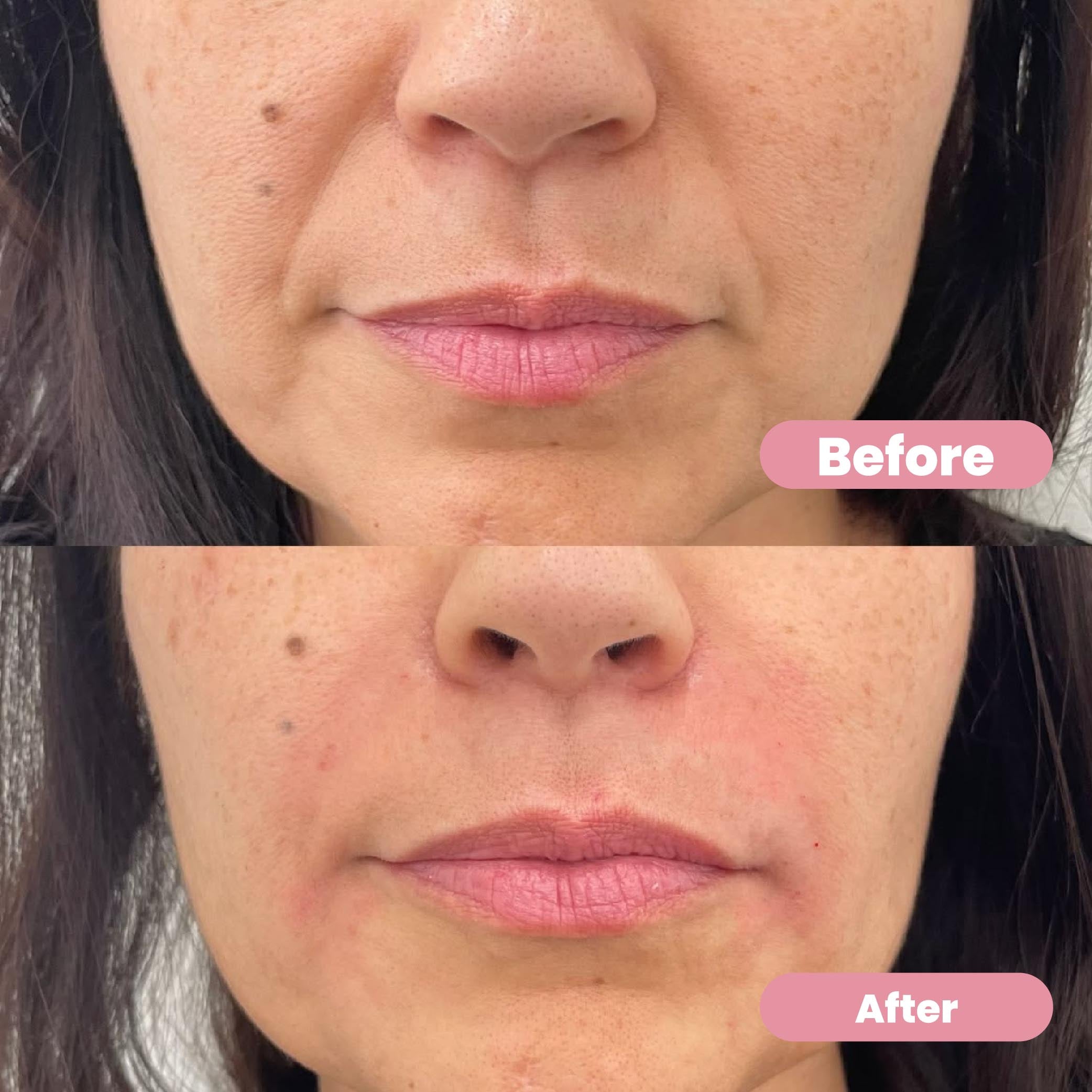 Ubiskin™ At-Home Rejuvenating Microinfusion System